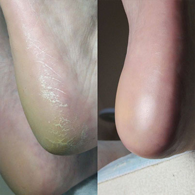 پدیکور در قشم